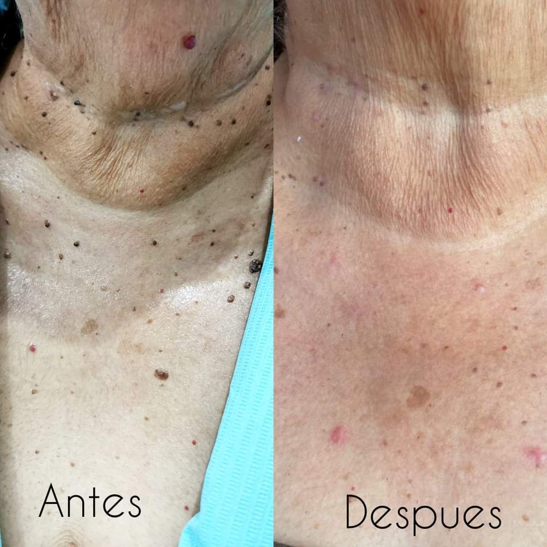 Crema Anti-Verrugas Aichun Beauty - Cuidado Dermatologico Localizado