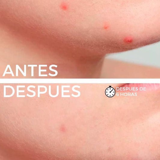 Parche Anti Acné Winner